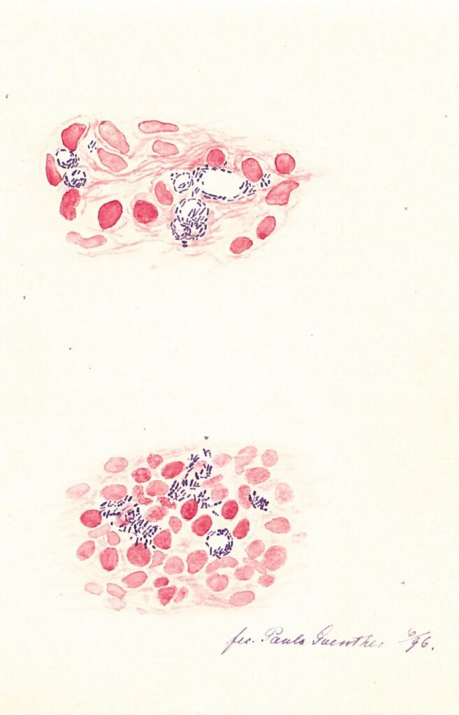 Drawing of stained leprosy bacteria. Regional State Archives of Bergen.