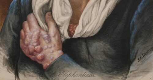 Detail from one of Lostings illustrations. Photo: Leprosy Museum St. Jørgen's Hospital.